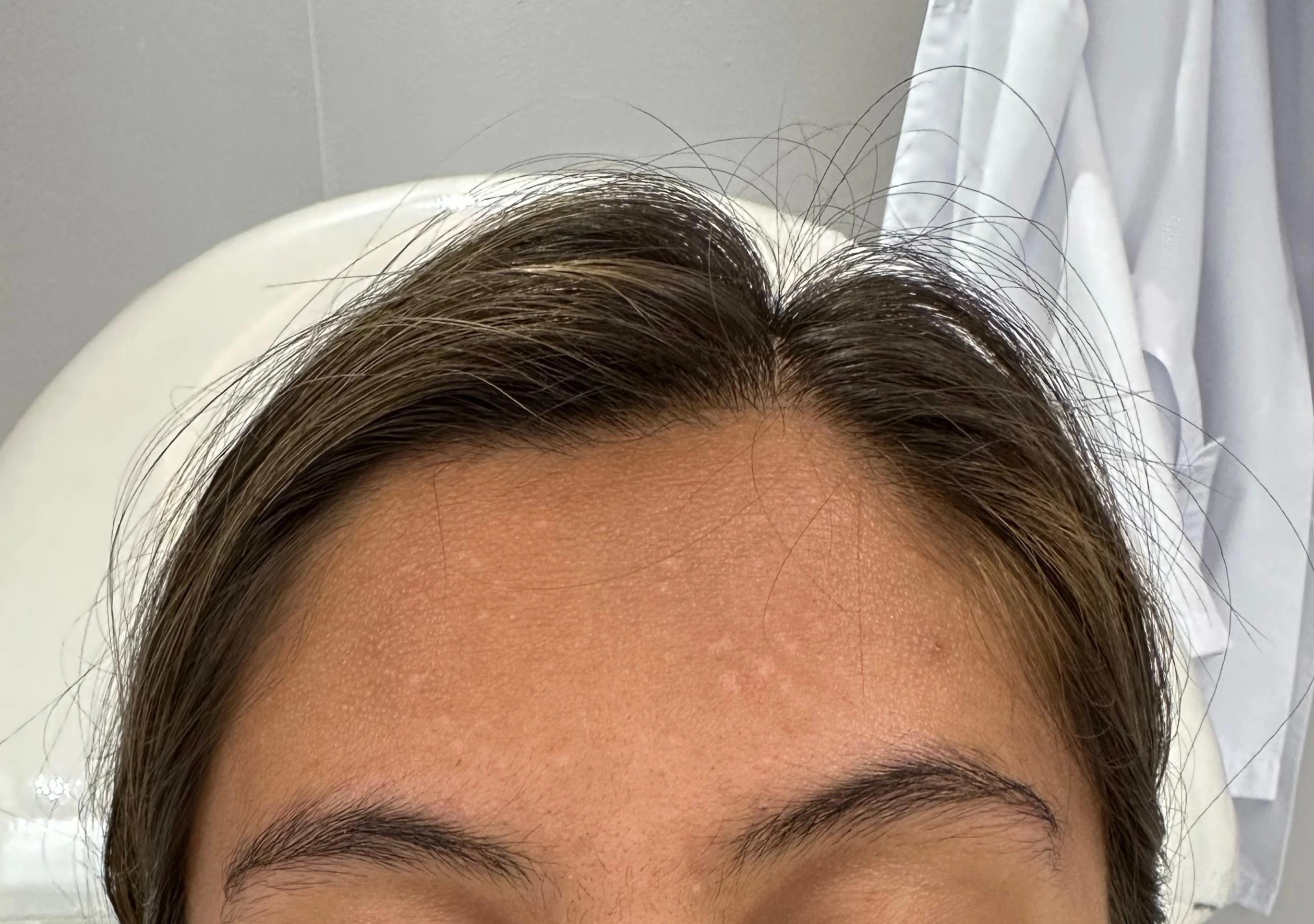 Tratamiento de Acné - Después